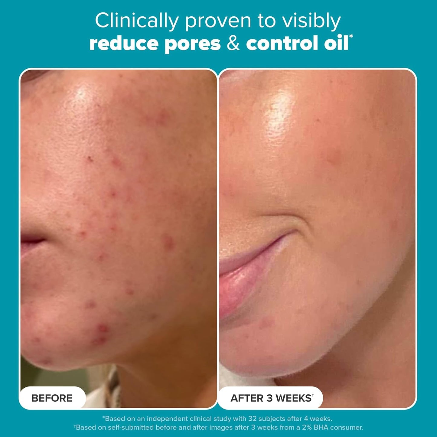 Paula's Choice SKIN PERFECTING 2% BHA Liquid Salicylic Acid Exfoliant-Facial Exfoliant for Blackheads, Enlarged Pores, Wrinkles & Fine Lines